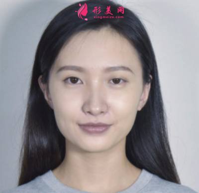 鄭州東方整形醫(yī)院雙眼皮修復(fù)案例