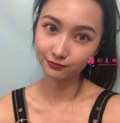 鄭州東方整形醫(yī)院雙眼皮修復(fù)案例