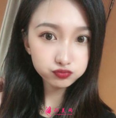 鄭州東方整形醫(yī)院雙眼皮修復(fù)案例