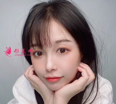上海華美做熱瑪吉怎么樣？術(shù)后三個(gè)月皮膚變得緊致了