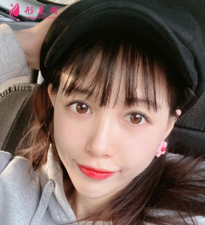 上海華美做熱瑪吉怎么樣？術(shù)后三個(gè)月皮膚變得緊致了