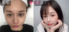 上海華美做熱瑪吉怎么樣？術后三個月皮膚變得緊致了