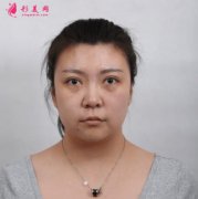 重慶時(shí)光醫(yī)院去眼袋90天案例~效果非常不錯(cuò)看圖吧！