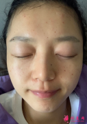 無錫同濟醫(yī)院皮秒激光就還你白皙肌膚，術后案例分享