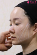重慶星榮整形外科醫(yī)院線雕效果怎么樣?術(shù)后效果對(duì)比圖一覽