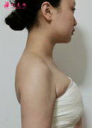 北京潤(rùn)美玉之光隆胸效果怎么樣？貴不貴？先來(lái)看看術(shù)后案例