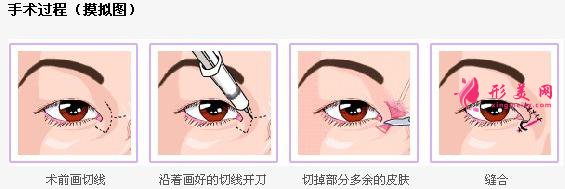 開眼角過程.jpg