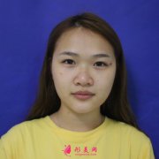 上海市第九人民醫(yī)院整形外科隆鼻案例~一起看看效果吧