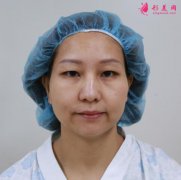 黃名斗自體脂肪填充怎么樣？案例真人術(shù)后效果反饋