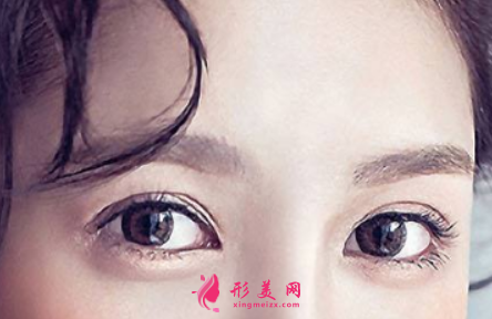 雙眼皮手術(shù)痛不痛呢