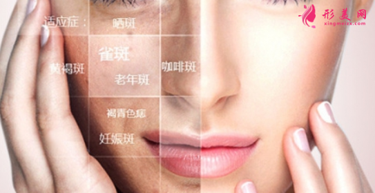 激光祛斑后有紅腫怎么辦