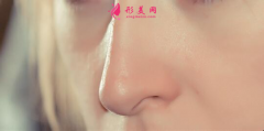 自體軟骨隆鼻術后會鈣化嗎？