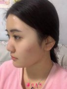江蘇省中醫(yī)院瘦臉針怎么樣?案例效果對比級項目價格表一覽