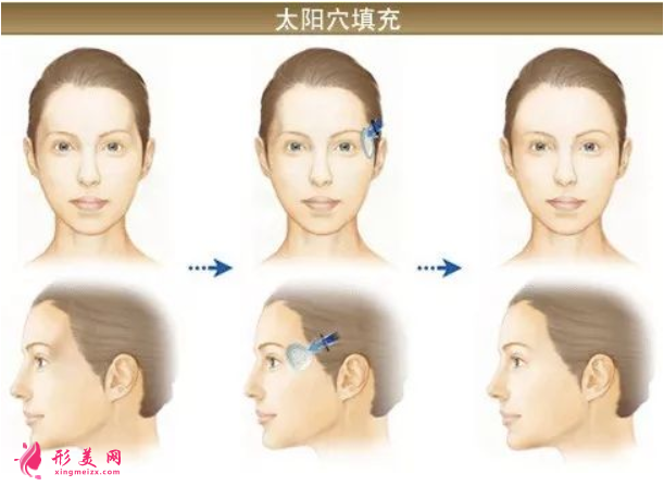 自體脂肪填充臉部后的注意事項(xiàng)