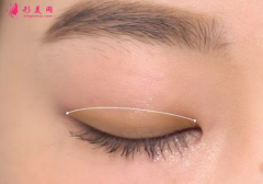 雙眼皮手術(shù)的風險大不大?