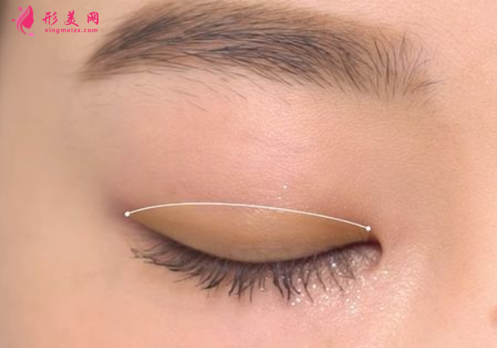 雙眼皮手術(shù)的風(fēng)險大不大