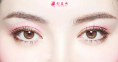 雙眼皮術(shù)后恢復(fù)的快慢跟什么有關(guān)？
