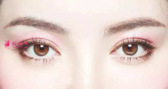 雙眼皮術(shù)后的恢復(fù)時(shí)間是多久？