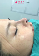 杭州維多利亞隆鼻怎么樣？耳軟骨隆鼻術后案例分享