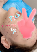 熱瑪吉效果好不好？一起來看看上海九院熱瑪吉術后案例分享