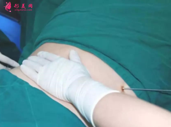 腰腹部吸脂需要住院嗎