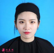 重慶星榮整形外科醫(yī)院怎么樣？看雙眼皮術(shù)后45天恢復(fù)效果圖一覽