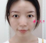 八大處范飛隆鼻效果咋樣？案例恢復圖一覽，范飛在線預約