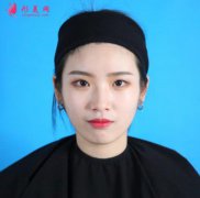 上海九院整形外科怎么樣？看雙眼皮術(shù)后45天恢復(fù)效果圖一覽