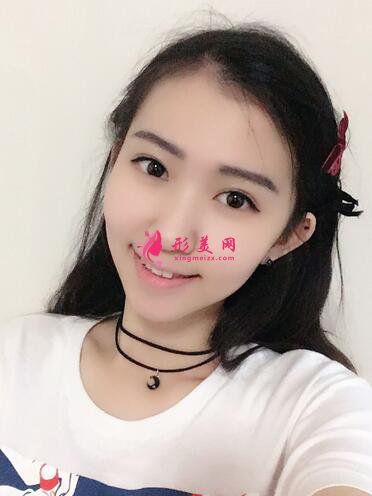 自體軟骨隆鼻術(shù)后遺癥有哪些？注意事項也很重要~