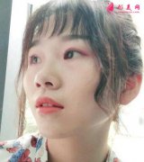 自體軟骨隆鼻術(shù)后遺癥有哪些？注意事項(xiàng)要做好