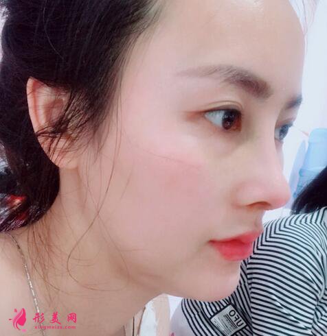 眼部整形手術(shù)價錢是多少？術(shù)后注意事項是什么？
