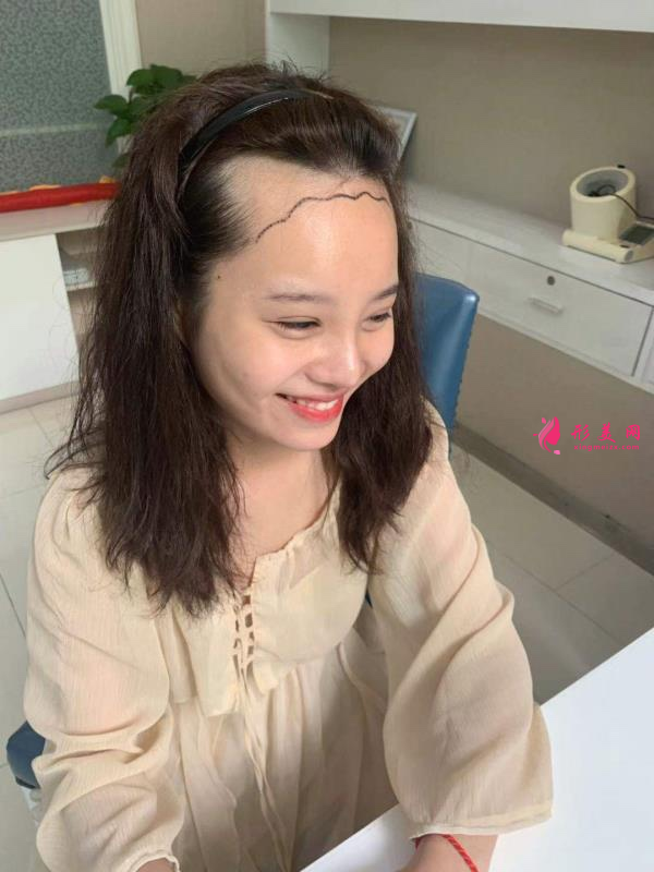 北京植發(fā)哪家醫(yī)院做的比較好？附植發(fā)案例+2021價(jià)格表