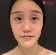 武漢同濟(jì)醫(yī)院整形科隆鼻案例+價格分享！效果非常不錯看圖吧！
