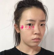 上海美聯(lián)臣整形醫(yī)院鼻綜合案例效果公布！含全新價格表