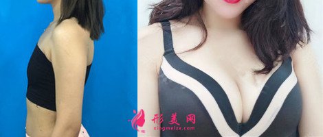 鄭州集美美容醫(yī)院隆胸案例 鄭州集美美容醫(yī)院隆胸案例