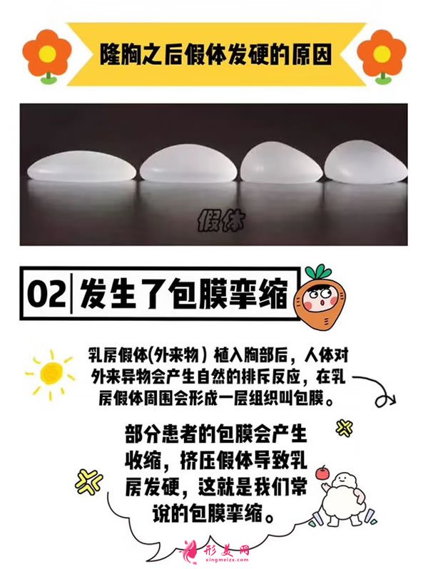 假體隆胸術(shù)后會(huì)不會(huì)發(fā)生包膜攣縮.jpg 假體隆胸術(shù)后會(huì)不會(huì)發(fā)生包膜攣縮.jpg