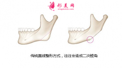 明星都做哪些輪廓整形手術(shù)，為什么很多人不建議做下頜角？
