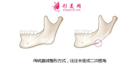 傳統(tǒng)下頜角手術(shù) 傳統(tǒng)下頜角手術(shù)