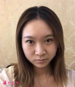 南京華韓裴炳萬醫(yī)生做鼻子怎么樣！前后對比變化圖