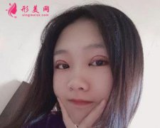 浙一醫(yī)院整形外科吳慧玲雙眼皮效果怎么樣？案例真實(shí)恢復(fù)圖