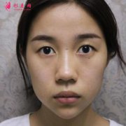 廣州荔醫(yī)雙眼皮好嗎？效果怎么樣？術(shù)后90天恢復(fù)效果圖分享