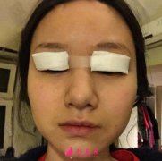 四川華美紫馨雙眼皮怎么樣？手術(shù)恢復(fù)過程真實經(jīng)驗分享