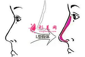 假體隆鼻 假體隆鼻