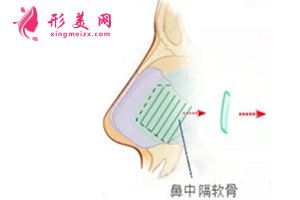 鼻中隔軟骨 鼻中隔軟骨
