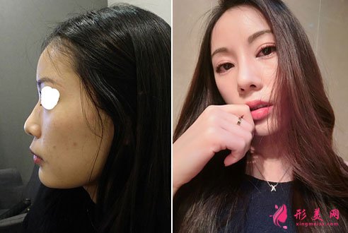 韓國普瑞美整形醫(yī)院隆鼻真人案例 韓國普瑞美整形醫(yī)院隆鼻真人案例