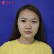 上海九院整形外科隆鼻案例~朋友們看看效果怎么樣吧~