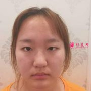 中國醫(yī)學(xué)科院整形外科醫(yī)院八大處怎么樣？附雙眼皮手術(shù)恢復(fù)過程圖