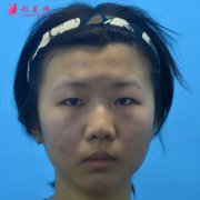 無錫同濟醫(yī)療美容醫(yī)院怎么樣？附雙眼皮恢復前后對比圖分享