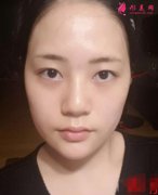 廣西醫(yī)科大第一附屬醫(yī)院瘦臉針案例效果圖！附2021價(jià)格標(biāo)準(zhǔn)