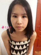 鄭州大學(xué)第二附屬醫(yī)院價格表2021均價顯示！含眼整形案例實拍圖